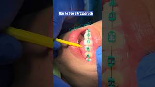 BRACES How to Use a Proxabrush [upl. by Dionne854]