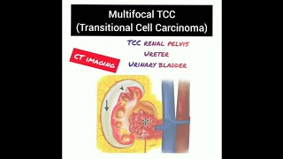 Case report Multicentric Transitional Cell Carcinoma TCC CT AbdomenRadiology 20 [upl. by Anomas]