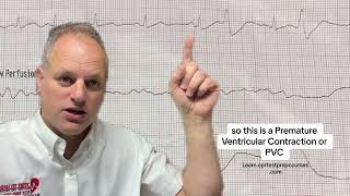 EKG analysis of PVC’s Premature Ventricular Contractions [upl. by Letnuahs892]