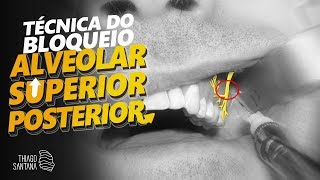 Anestesia por bloqueio do nervo alveolar superior posterior [upl. by Naraa]