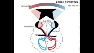 binasal hemianopia [upl. by Talley91]