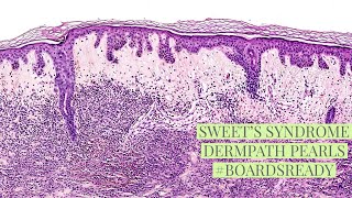 Sweet’s disease explained by a dermatopathologist Unk 16 [upl. by Lenard]