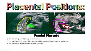 Placenta Positions on Ultrasound  AnteriorPosteriorFundalLateral Placental Positioning USG [upl. by Zusman]