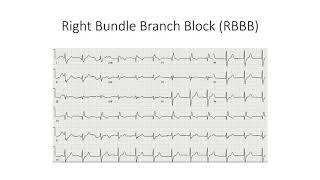 Cardiac Arrhythmia  Part4  Ventricular Dysrhythmia  Ventricular Tachycardia  Causes  Treatment [upl. by Htinek]