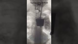 A tracheoesophageal fistula TEF radiology paediatric clinical neetpg [upl. by Libby]