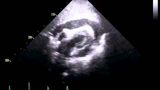 Echocardiogram of a Patient With Cardiac Tamponade [upl. by D'Arcy849]