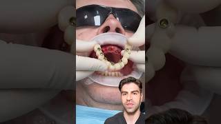 Tooth Implants All On 4  Explained [upl. by Berlin412]