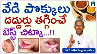 వేడి పొక్కులు దద్దుర్లు తగ్గించే బెస్ట్ చిట్కా  Manthena satyanarayana Raju VideosHealth Mantra [upl. by Maleeny396]