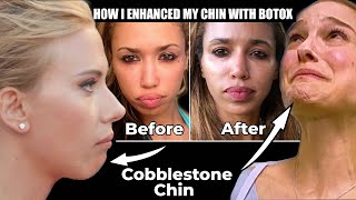 Botox to the Chin Before and Afters  What is Cobblestone chin [upl. by Langer]