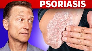 Psoriasis Treatment – The Best 3 Remedies for Psoriasis – DrBerg [upl. by Grimona181]