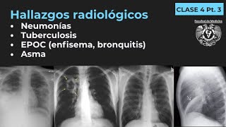 043  Neumonía TB EPOC Enfisema Bronquitis Bronquiectasias Asma [upl. by Davis]