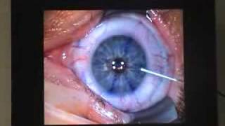 Opération lasik des yeux pour corriger les défauts visuels [upl. by Frederic994]