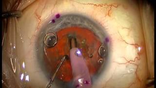 Cataract Surgery for Astigmatism  Toric Intraocular Lens Implantation [upl. by Goddart]