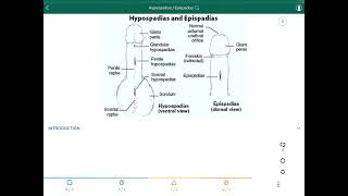 Hypospadias  Epispadias  فتحة الأحليل السفلية  فتحة الأحليل العلوية [upl. by Gaudet290]