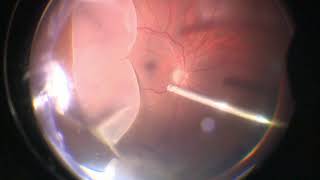 Vitrectomy for Giant Retinal Tear  Retinal Detachment  GRT  Dr Manish Nagpal [upl. by Millie]