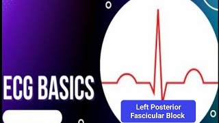 ECG Basics  Left Posterior Fascicular Block ECG Criteria and Electrophysiology of LPFB [upl. by Nika]