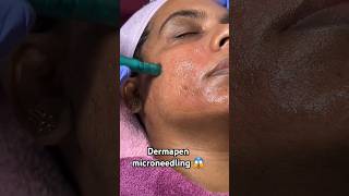 Dermapen microneedling for Skin Brightening ✨️ dermapen microneedling soyaburygirl [upl. by Nylhtiak]