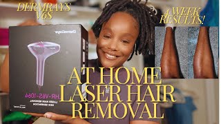 AT HOME LASER HAIR REMOVAL FOR MELANATED SKIN DERMRAYS V6S REVIEW [upl. by Oilerua693]