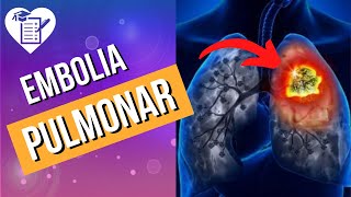 EMBOLIA PULMONAR – Causas Sintomas e Tratamento [upl. by Xonel]