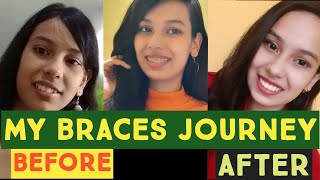 braces time lapseMy braces journeyq n a related to bracesall about bracesbraces transformation [upl. by Zertnom520]