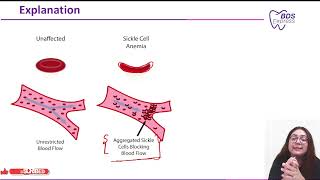 NEET MDS 2023 Pathology  Sclerotic Dentin [upl. by Charlet]