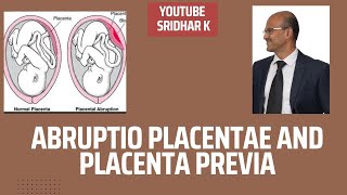 Abruptio placentae and placenta previawhat are these conditions APH bleeding abruption previa [upl. by Aicnatsnoc454]