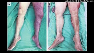 Phlegmasia Cerulea Dolens with Compartment Syndrome [upl. by Britni]