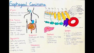 Esophageal Cancer  What you need to know [upl. by Blancha]