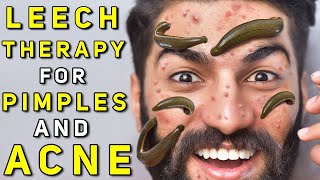 Leech Therapy for Skin Problems like Acne Pimples [upl. by Kwok]