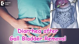 Diarrhea after Laparoscopic Cholecystectomy OR Gall Bladder Surgery  Dr Nanda Rajaneesh [upl. by Gillmore418]