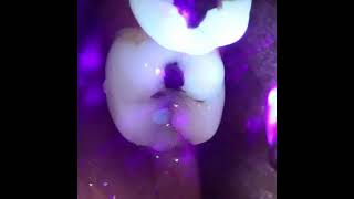 Showing a cracked tooth using transillumination with a curing light [upl. by Ppik]