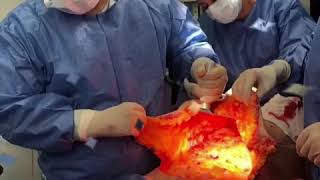 Abdominoplastia Dr Hernando Tenorio [upl. by Primaveras]