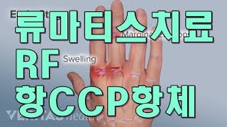 류마티스Rheumatoid Arthritis 치료  RF anti CCP antibody [upl. by Vickey896]