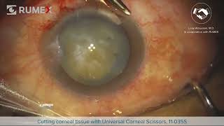 Surgery Live Cutting Corneal Tissue [upl. by Omrellug]