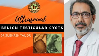 BENIGN TESTICULAR CYSTS  DR SUBHASH TAILOR  SCROTAL ULTRASOUND  TESTES DOPPLER  TUBULAR ECTASIA [upl. by Joshua]