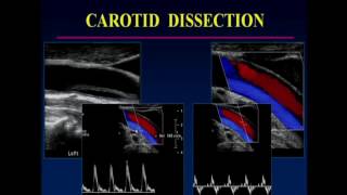 Non Atherosclerotic pathology of the Carotid Arteries [upl. by Sylvanus]