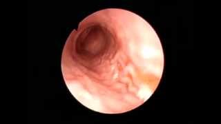 Gastroscopy Erosive antral gastritis [upl. by Templas520]