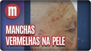 Saúde Manchas Vermelhas na Pele  Mulheres 080217 [upl. by Seidel]