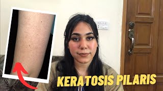 Strawberry Skin Treatment  Keratosis Pilaris  Shamaimrajpoot [upl. by Aettam37]