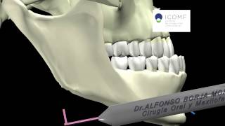 OSTEOTOMIA INTRAORAL VERTICAL DE RAMA MANDIBULAR [upl. by Howland]