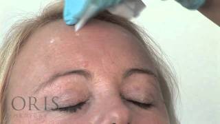 Botox training  Forehead Lines  Oris Medical [upl. by Arhas]