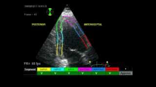 RESTRICITIVE CARDIOMYOPATHY ECHO [upl. by Mendez]