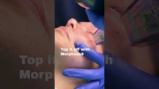 Filler Complications Repair lasertreatment microneedling nanofat fillerdissolving [upl. by Eniamrehs]