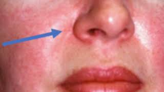 How To Treat Dermatomyositis  Causes  Diagnosis and Treatment [upl. by Ilecara]