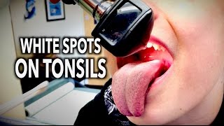 WHITE SPOTS ON TONSILS  Dr Paul [upl. by Annayk]