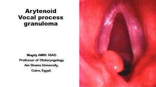 Arytenoid vocal process Granulomas [upl. by Saraann]