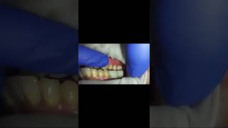 Excess prosthetic space in lower missing molarsimmediate loadingdental implants resorbed Mandible [upl. by Surovy271]