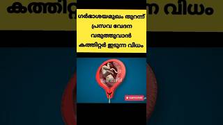 പ്രസവ വേദന വരുത്തുവാൻ കത്തിറ്റർ ഇടുന്നത് ഇങ്ങനെ pregnancy trending shortsmalayalam [upl. by Ynnig242]