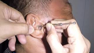 Something MASSIVE Stuck amp Removed From Mans Ear [upl. by Proudman593]