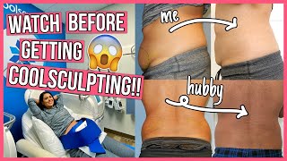 SHOCKING Coolsculpting Before amp After 6 Things You NEED to Know [upl. by Baxy]